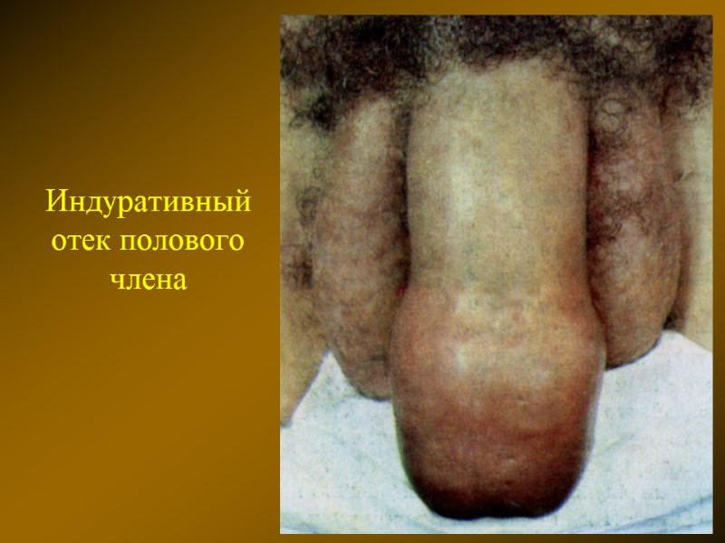 Индуративный отек полового члена